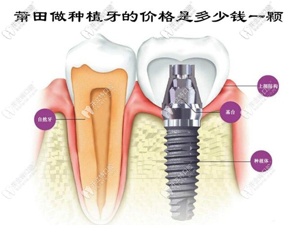 莆田做種植牙的價格是多少錢一顆
