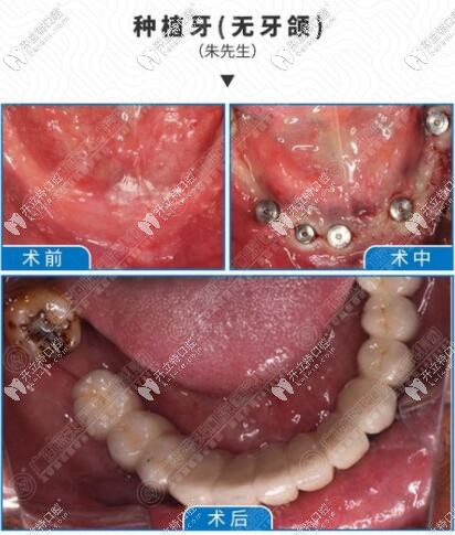 藍天口腔醫(yī)院種植牙案例