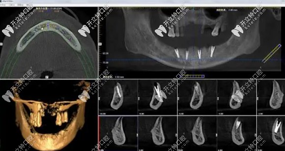 ALL-ON-4種植牙的3D動畫演示圖