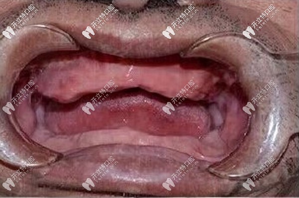 陳叔叔全口種植牙前