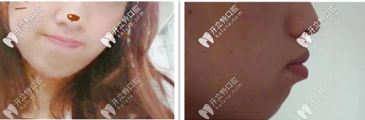 抿嘴的時(shí)候看起來就特別突兀，側(cè)顏突出
