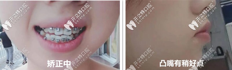 后來慢慢的開始有變化了，牙齒感覺在內(nèi)收了