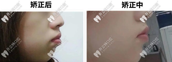岳陽平江致遠(yuǎn)口腔：做的金屬自鎖矯正