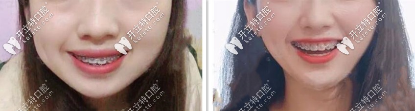 這時(shí)笑起來都不會覺得凸了，想不想初戀臉，哈哈哈哈