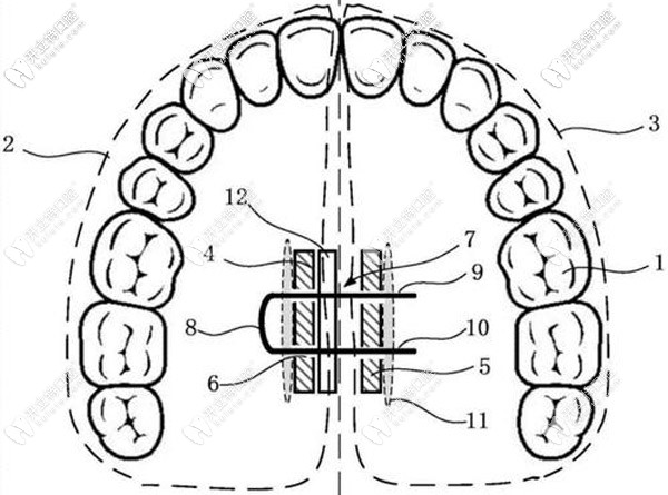 牙齒擴(kuò)弓器的特點(diǎn)