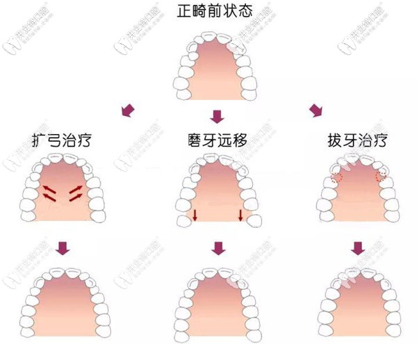 牙齒矯正使用擴(kuò)弓、磨牙遠(yuǎn)移、拔牙等都行