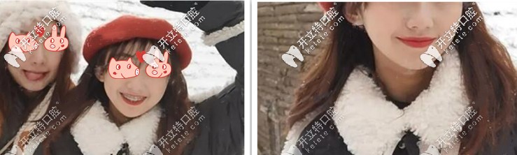 愛了愛了，簡直了，這矯正效果