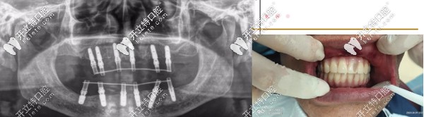 通過(guò)ALL-ON-6種植技術(shù)獲滿口好牙