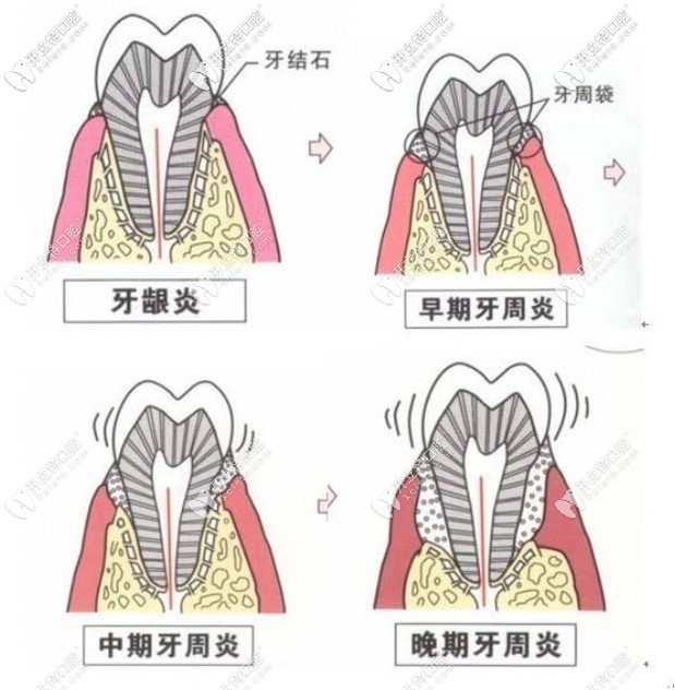 牙齦炎和牙周炎區(qū)別圖片