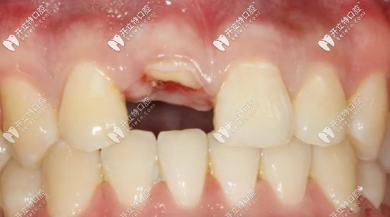 前牙區(qū)應用盾構術進行即刻種植案例更新,美學效果更贊！