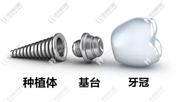 種植牙由種植牙、基臺(tái)及牙冠組成