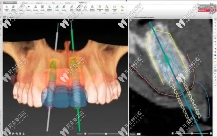 種植術前定位系統(tǒng)