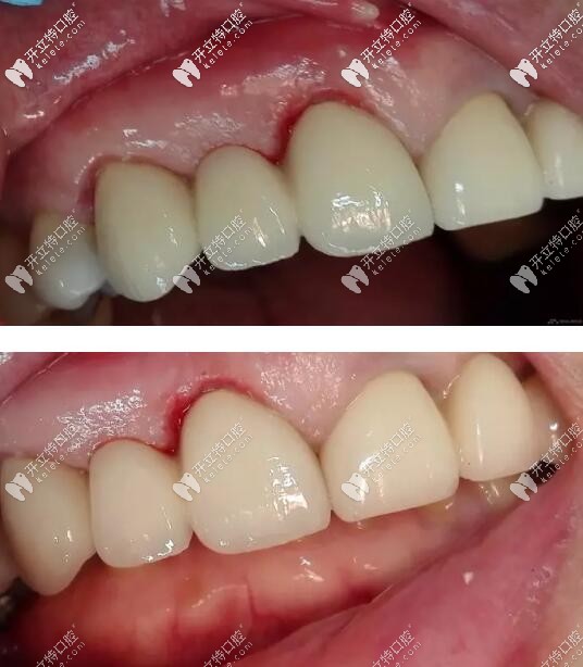 殘根帶牙冠修復(fù)案例