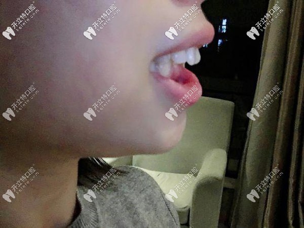 35歲骨性深覆合可以做舌側(cè)隱形矯正嗎?聽說花5萬臉型改變大