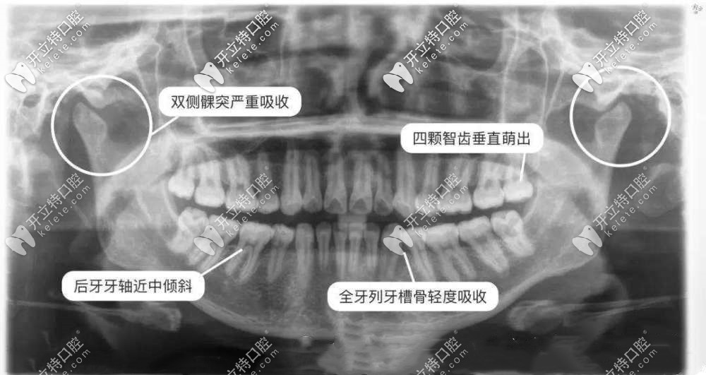矯正牙齒/拔牙為啥要拍片？拍牙片輻射危害有多大