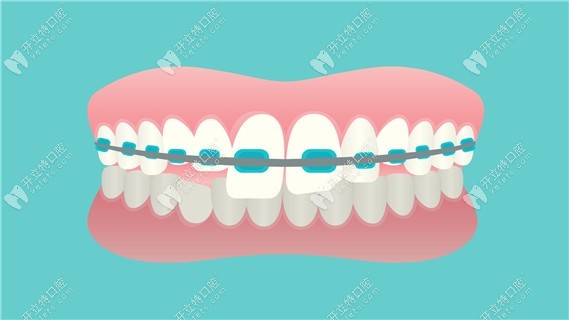 我戴的是陶瓷托槽矯正器