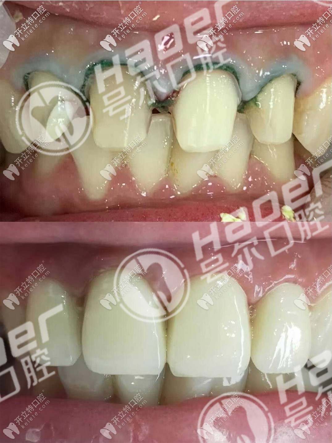 說不痛苦是假的,談?wù)勎铱敬裳烙?年后拆了換全瓷牙過程！