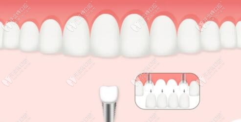 有足夠骨組織和無明顯炎癥的人群：都可做即刻種植