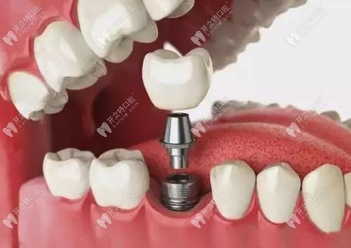 即刻負重為什么能當(dāng)天戴牙