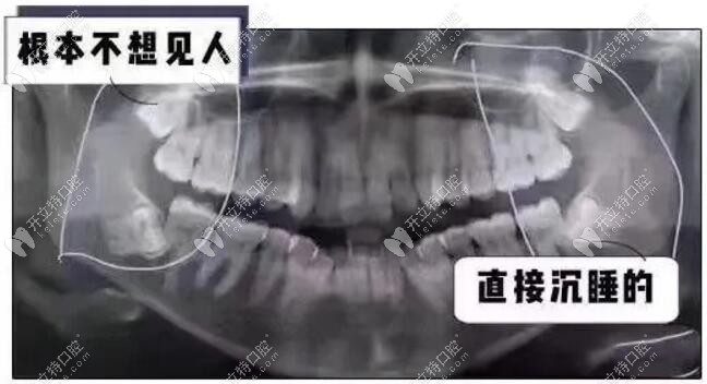 長(zhǎng)得很對(duì)稱，4顆智齒清潔不到