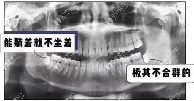 阻生牙、阻生智齒（橫著生長(zhǎng)）