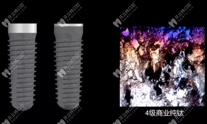 德國進(jìn)口種植體品牌camlog好不好？看其材質(zhì)性價(jià)比蠻高的