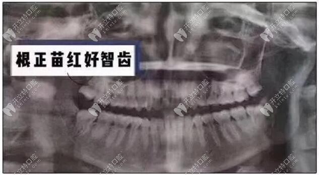 單邊長(zhǎng)了1顆智齒牙影響咬合功能