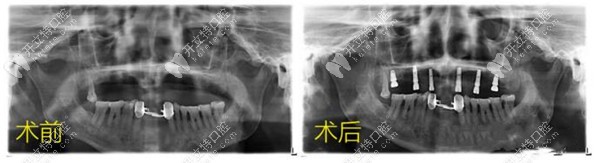 種植牙前后對(duì)比