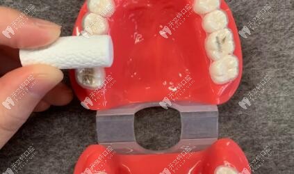 正確的咬膠放置位置——應(yīng)該覆蓋整個(gè)牙面