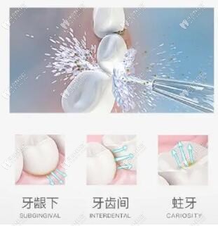 沖牙器適應(yīng)癥