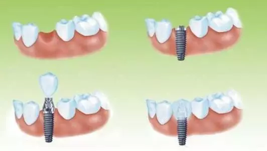 單顆牙缺失種植過程