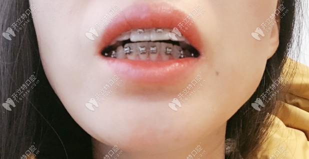 矯正中牙齒有變化 矯正中牙齒有變化