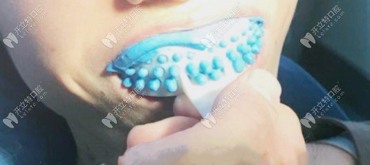 當(dāng)天咬模型 當(dāng)天咬模型