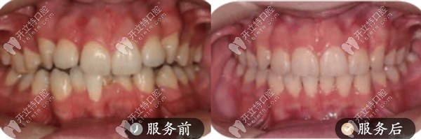 正畸案例-舌側矯正