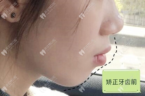 齙牙凸嘴矯正前