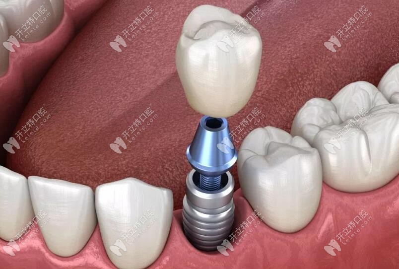 即刻種植、即刻負(fù)重技術(shù)優(yōu)勢