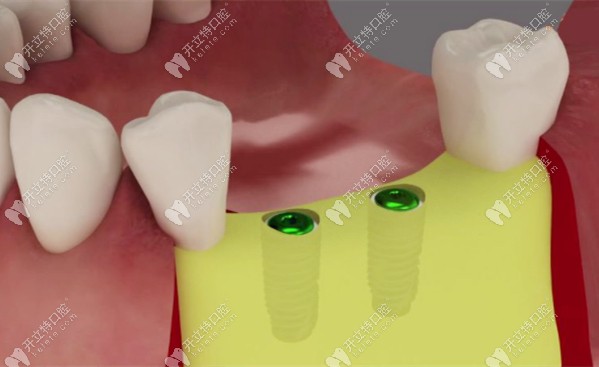 什么是骨擠壓技術(shù)