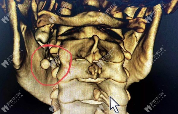罕見的涎石癥也會(huì)引起口腔下頜腫脹、疼痛