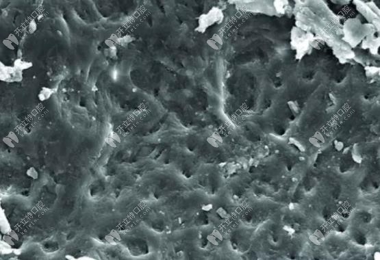 沒有沖洗過的根管鈣化外觀