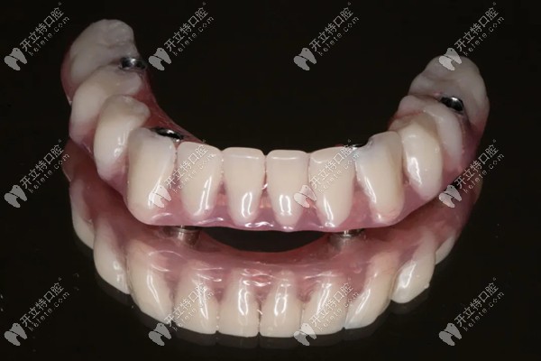 隔壁爺爺做的事ALL-on-4種植牙