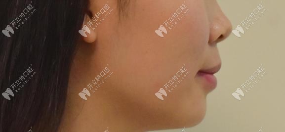 完成矯正后的側面變化 完成矯正后的側面變化