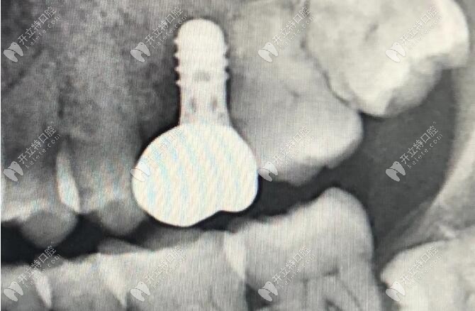 吸煙是種植牙的死敵?這個抽煙得種植體周圍炎的案例來解答