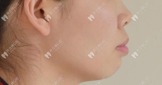 矯正前我的側面情況 矯正前我的側面情況