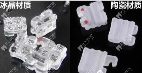 價(jià)格相差幾千的單晶托槽和陶瓷半隱形矯正到底有啥區(qū)別