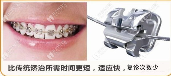 美國(guó)damon自鎖托槽快速矯正的技術(shù)原理