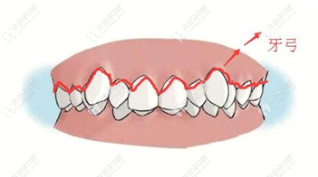 傳統(tǒng)方式需要擴(kuò)弓來矯正
