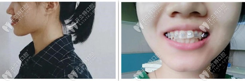 牙套兩個(gè)月側(cè)臉，嘴還是突