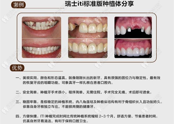 瑞士iti標準版種植牙案例