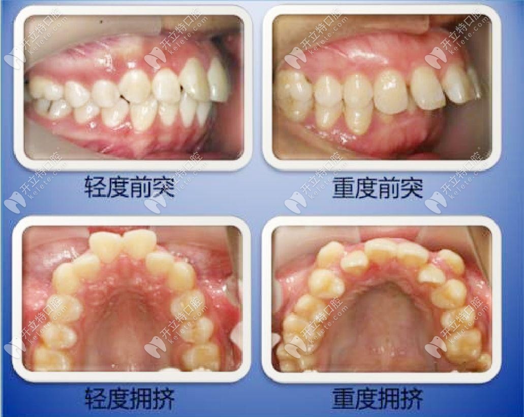 什么情況下需要拔牙才能矯正牙齒？