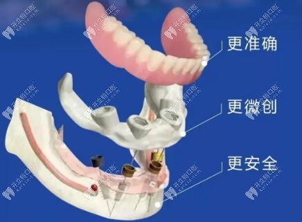 ?老話新談：中諾立得用種植牙好在哪兒？能用多久？